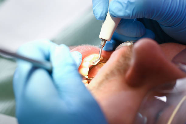 Best Knocked-Out Tooth (Avulsed Tooth) Treatment in Prairie Village, KS