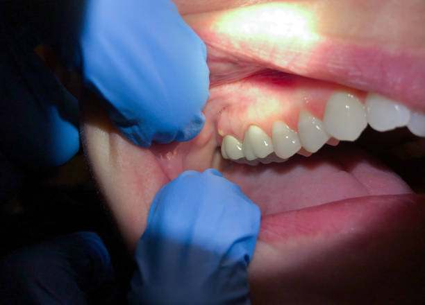 Best Emergency Treatment for Oral Infections in Prairie Village, KS